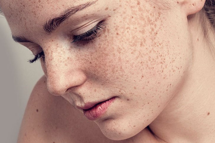 Чому з'являються пігментні плями на обличчі і як їх позбутися